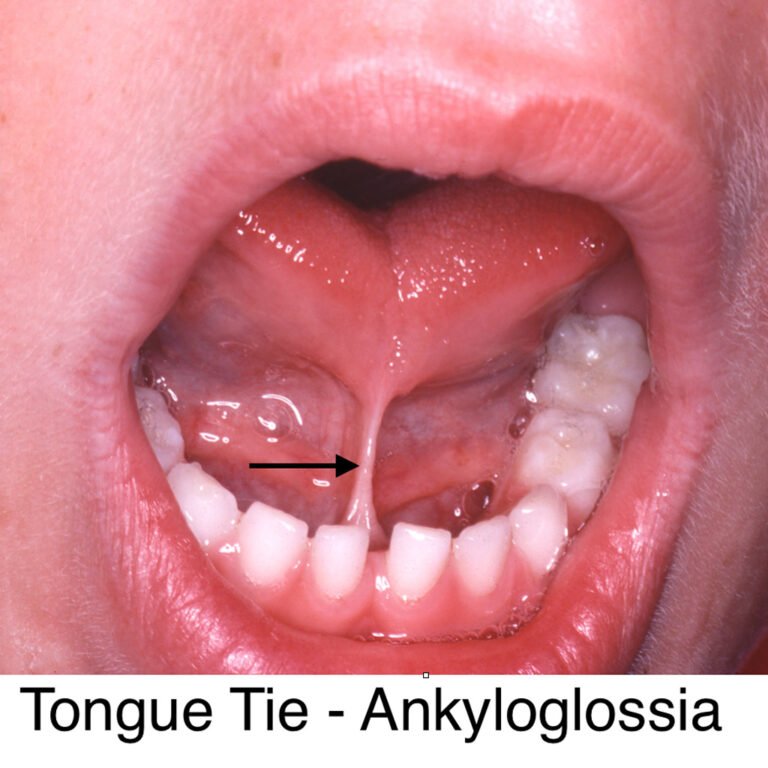 Tongue-Tie-Ankyloglossia