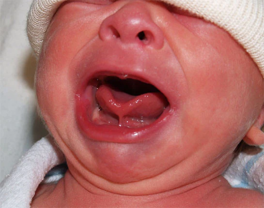 How do I know if my new born has a tongue tie?