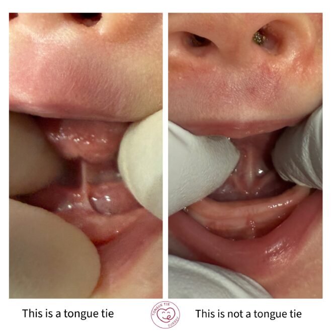 Is this a tongue tie?
