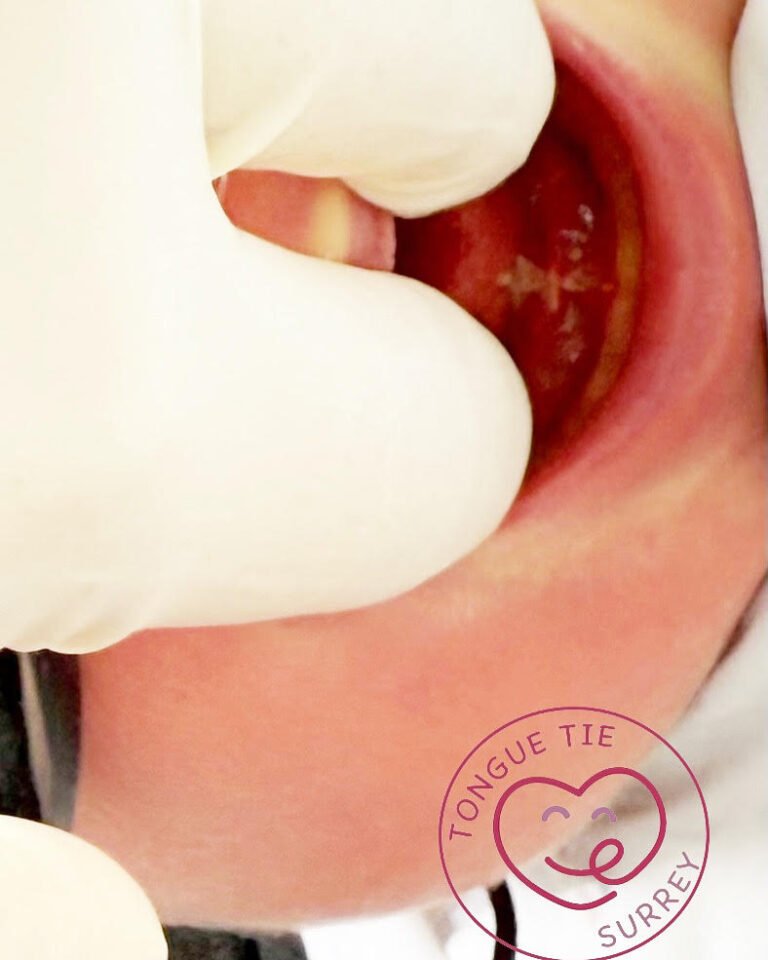 understanding what a healing tongue tie release wound is like